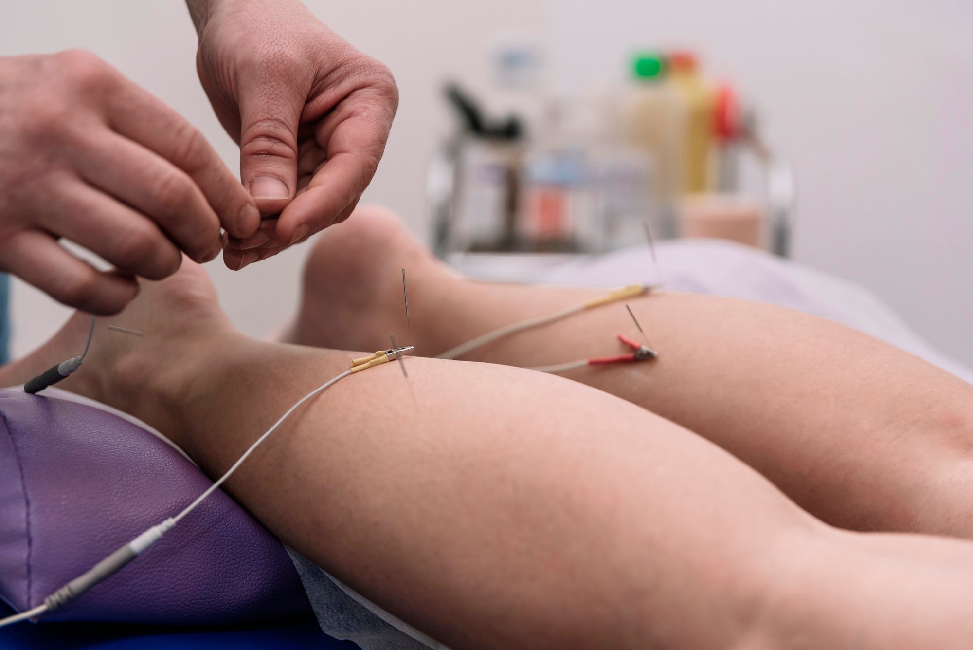 electrical-stimulation-in-physiotherapy-in-the-phy-2025-03-13-01-23-18-utc (1)