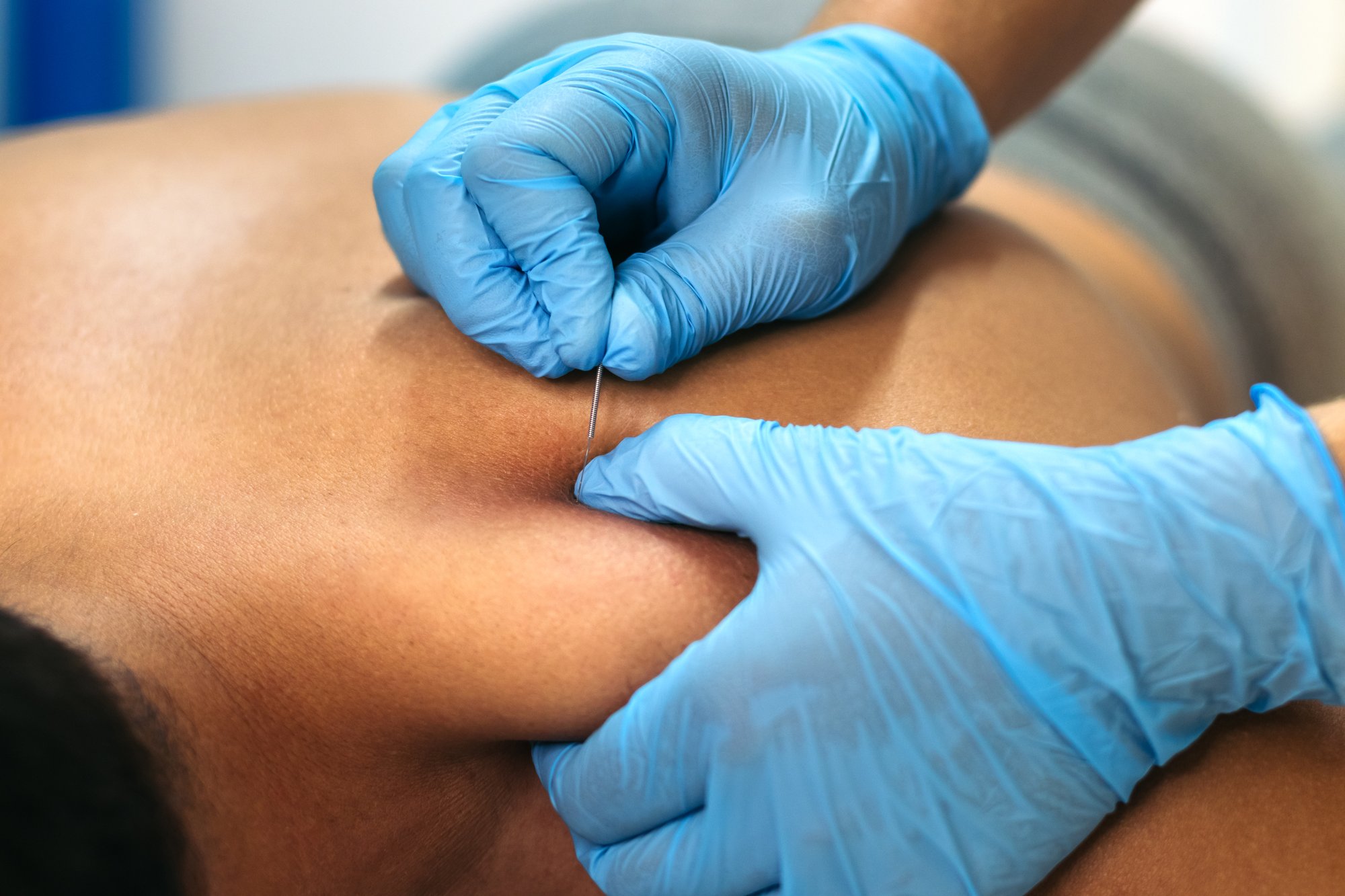 physiotherapy-clinic-dry-needling-2025-03-23-18-41-10-utc (1)